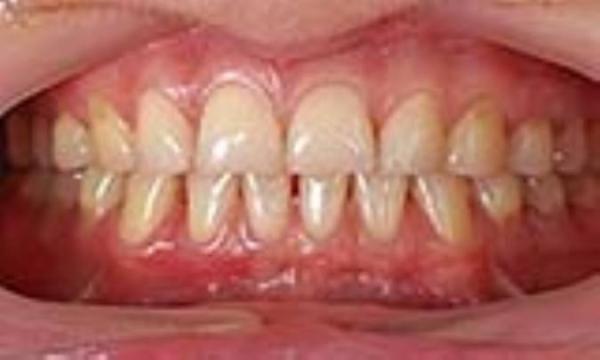علائم عفونت لثه علائم عفونت لثه